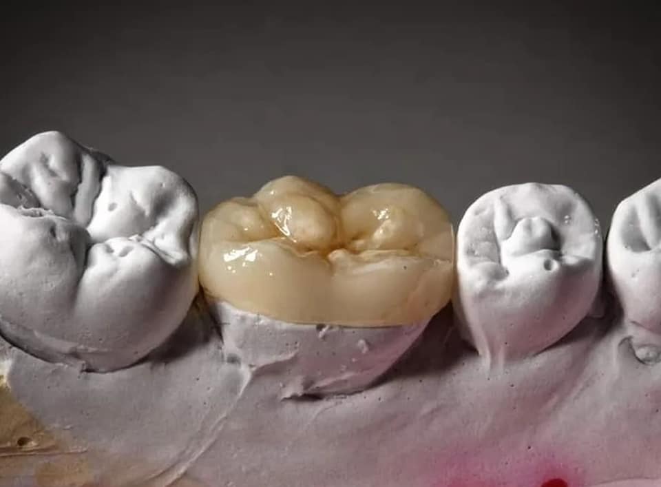 Modern All Ceramic Restoration for Endodontically Treated Tooth