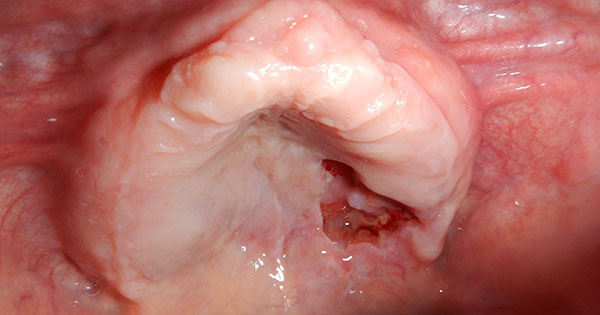 Excellence in Oral Mucosal Disease Management Ep. I