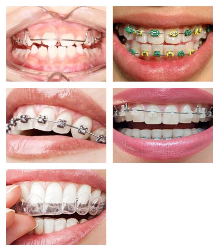 orthodontics services types คณะทันตแพทยศาสตร์ จุฬาลงกรณ์มหาวิทยาลัย