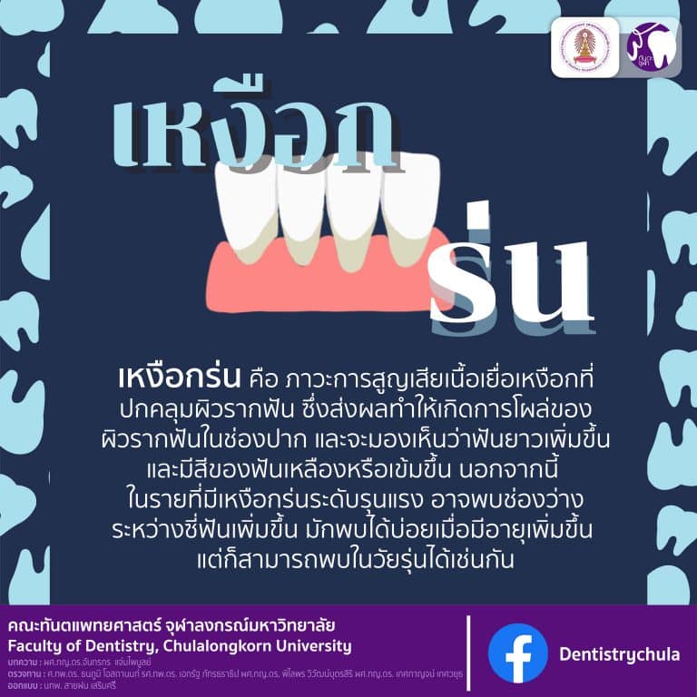 สาระน่ารู้กับทันตะจุฬาฯ : เหงือกร่น