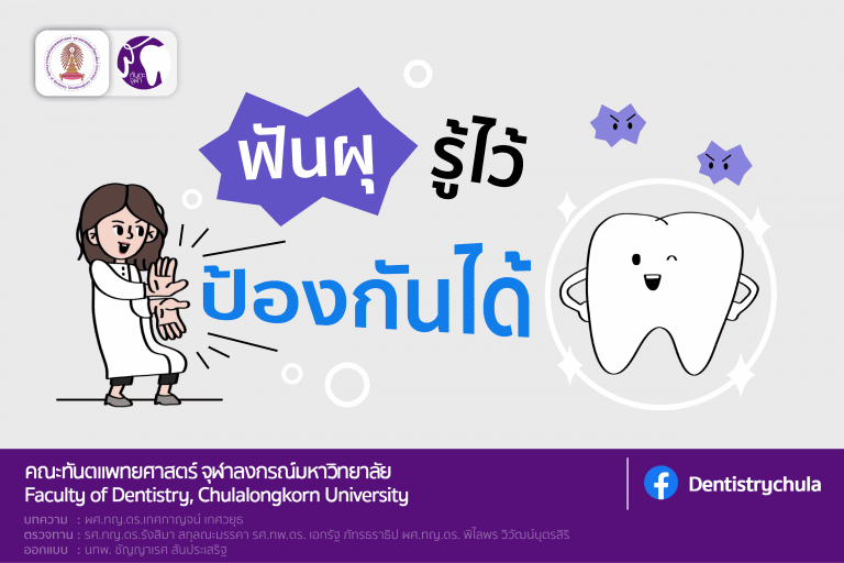สาระน่ารู้กับทันตะจุฬาฯ : ฟันผุ รู้ไว้ ป้องกันได้