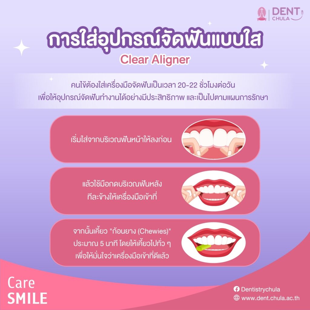 LINE ALBUM Clear Aligner 240123 3 คณะทันตแพทยศาสตร์ จุฬาลงกรณ์มหาวิทยาลัย