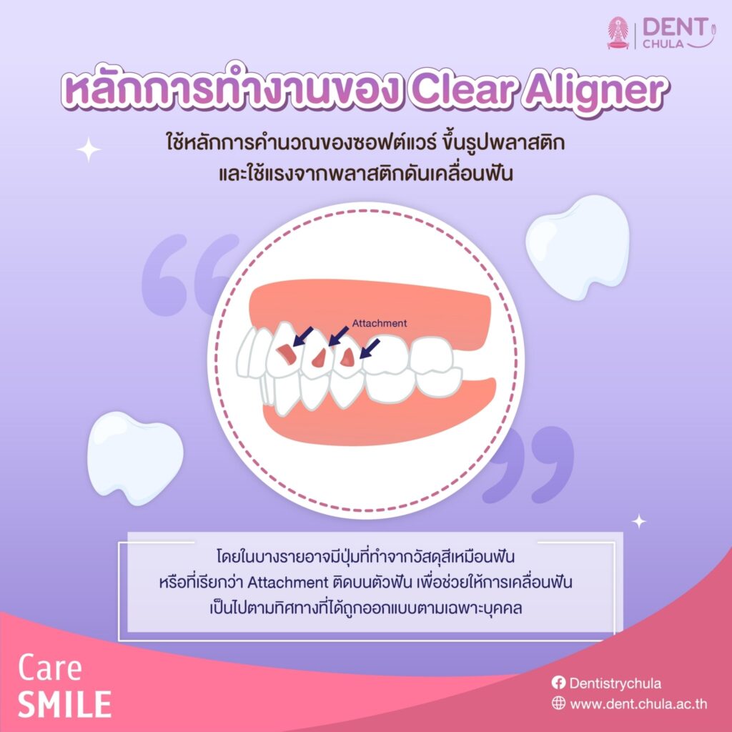 LINE ALBUM Clear Aligner 240123 6 คณะทันตแพทยศาสตร์ จุฬาลงกรณ์มหาวิทยาลัย