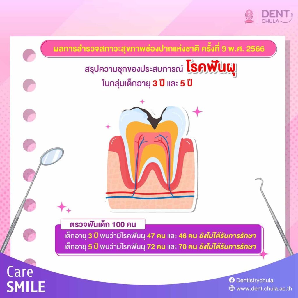 ผลการสำรวจสุขภาพช่องปากเกี่ยวกับประสบการณ์โรคฟันผุในกลุ่มเด็กอายุ 3 ปี และ 5 ปี