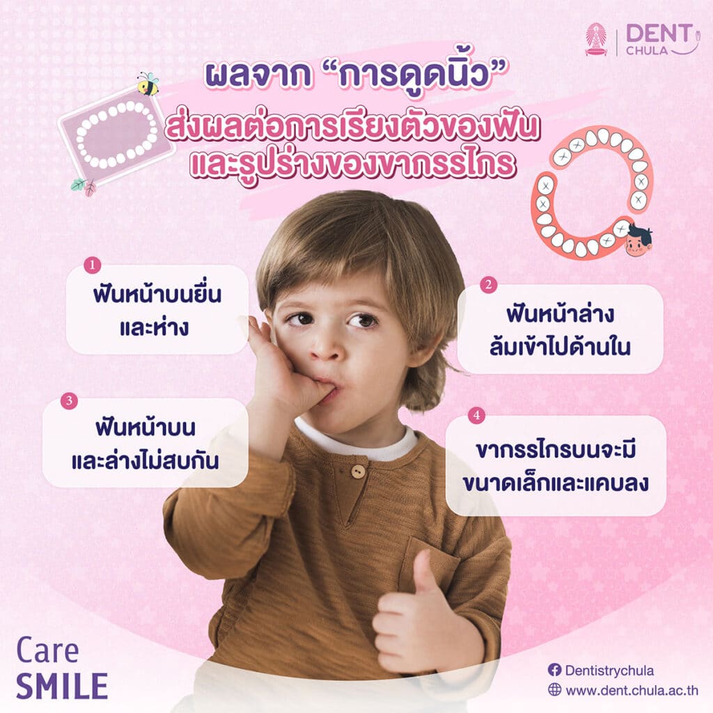 การดูดนิ้วส่งผลต่อการเรียงตัวของฟันและรูปร่างของขากรรไกร