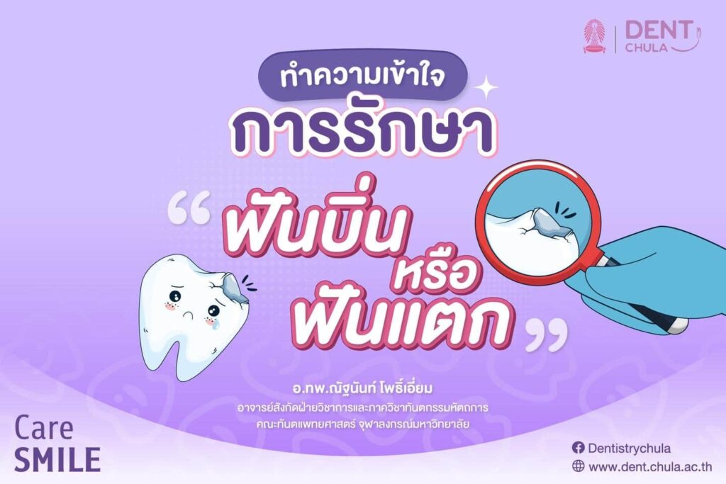 ฟันบิ่นหรือฟันแตก 01 คณะทันตแพทยศาสตร์ จุฬาลงกรณ์มหาวิทยาลัย