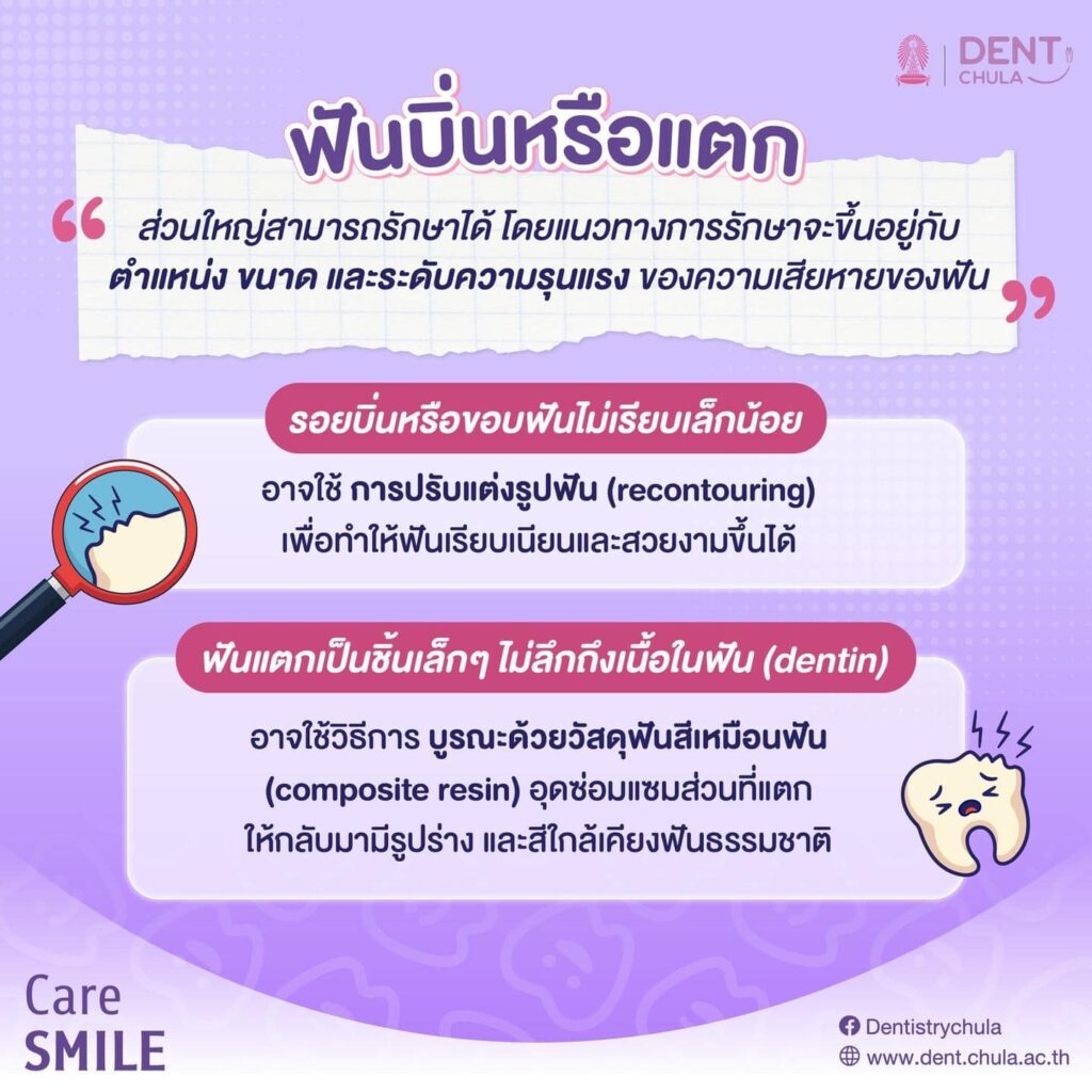 ฟันบิ่นหรือฟันแตก 02 คณะทันตแพทยศาสตร์ จุฬาลงกรณ์มหาวิทยาลัย