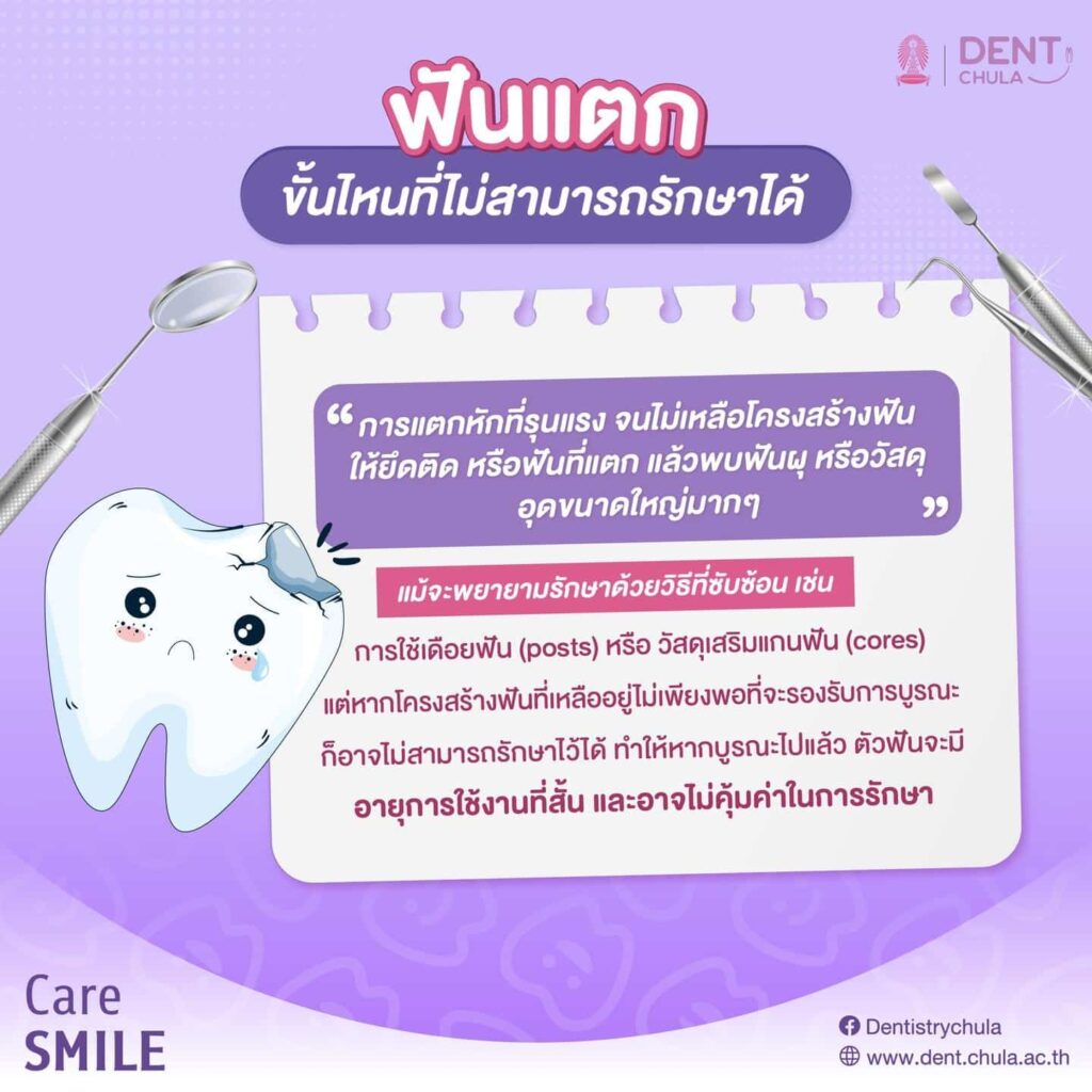 ฟันบิ่นหรือฟันแตก 04 คณะทันตแพทยศาสตร์ จุฬาลงกรณ์มหาวิทยาลัย