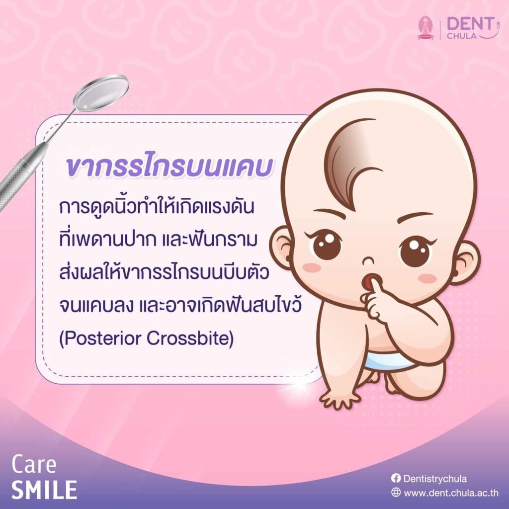 เด็กดูดนิ้วมือ 03 คณะทันตแพทยศาสตร์ จุฬาลงกรณ์มหาวิทยาลัย