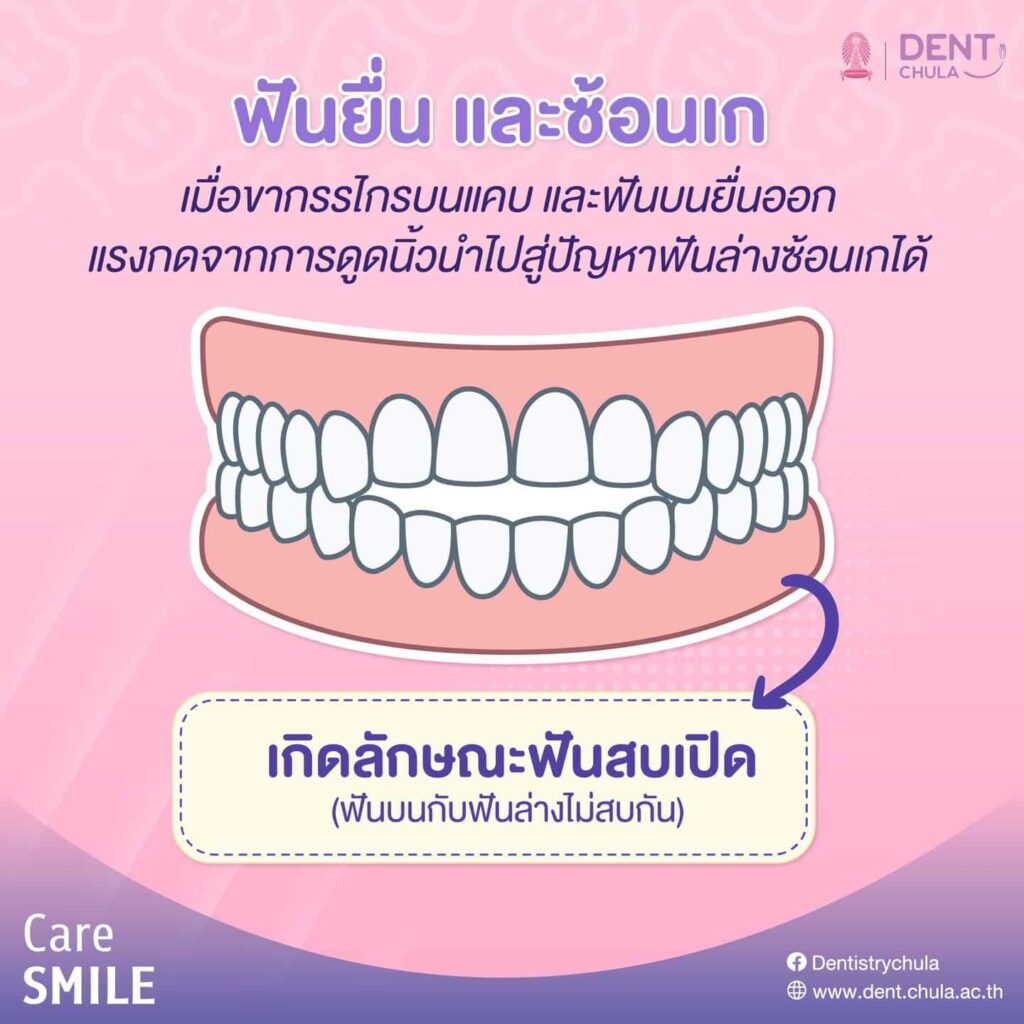 เด็กดูดนิ้วมือ 04 คณะทันตแพทยศาสตร์ จุฬาลงกรณ์มหาวิทยาลัย