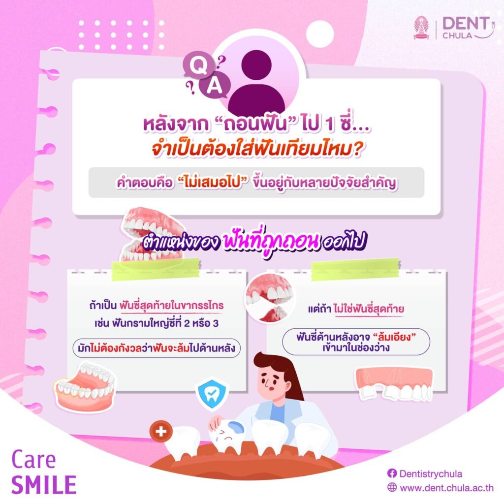 ถอนฟันออกไป 1 ซี่ 01 0 คณะทันตแพทยศาสตร์ จุฬาลงกรณ์มหาวิทยาลัย