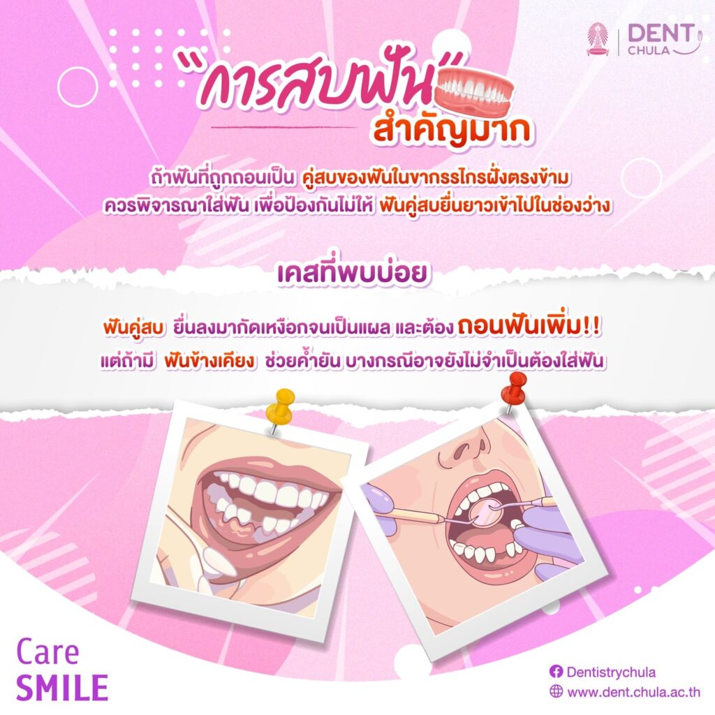 ถอนฟันออกไป 1 ซี่ 03 0 คณะทันตแพทยศาสตร์ จุฬาลงกรณ์มหาวิทยาลัย