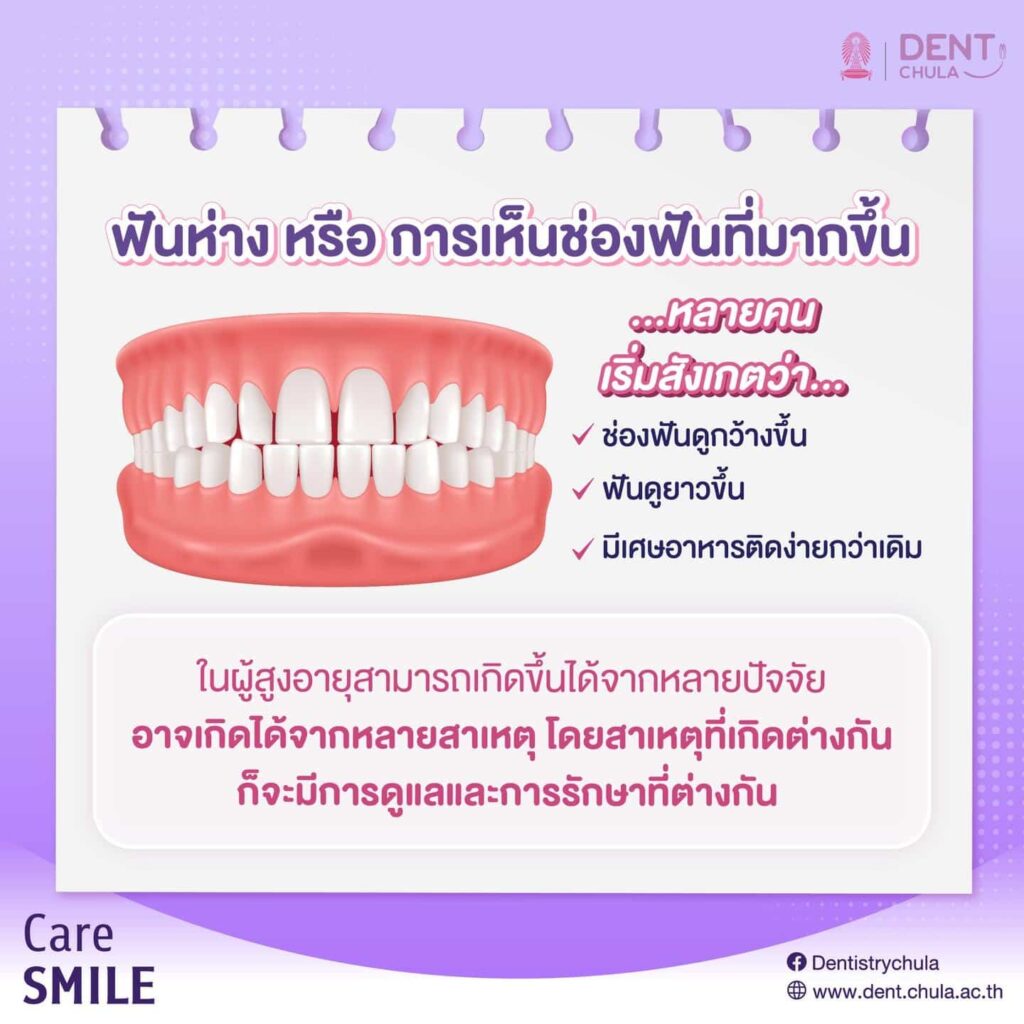 ฟันห่างตามวัย 02 คณะทันตแพทยศาสตร์ จุฬาลงกรณ์มหาวิทยาลัย