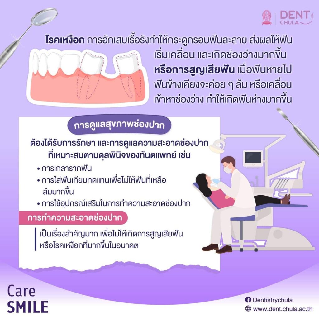 ฟันห่างตามวัย 04 คณะทันตแพทยศาสตร์ จุฬาลงกรณ์มหาวิทยาลัย