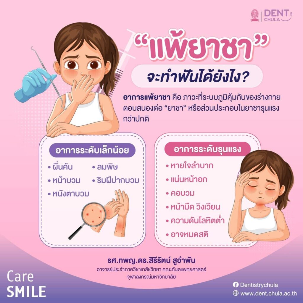 แพ้ยาชา 01 คณะทันตแพทยศาสตร์ จุฬาลงกรณ์มหาวิทยาลัย