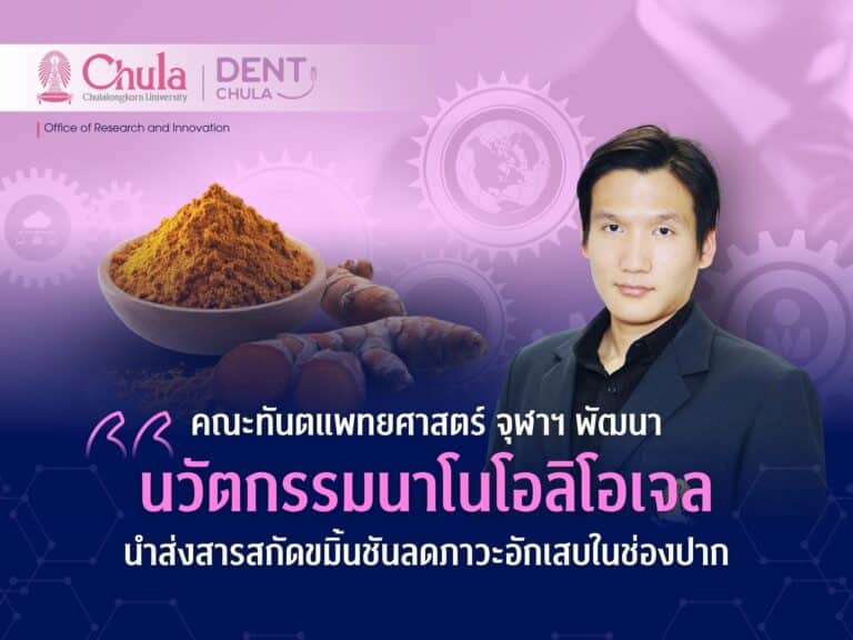 คณะทันตแพทยศาสตร์ จุฬาฯ พัฒนา “นวัตกรรมนาโนโอลิโอเจล” ลดภาวะอักเสบในช่องปาก