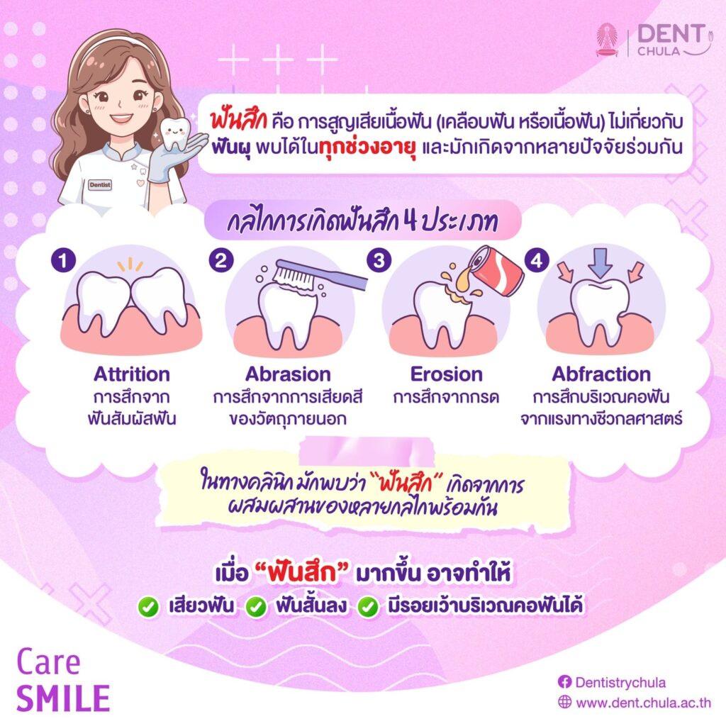 ปัญหาฟันสึก 2 0 คณะทันตแพทยศาสตร์ จุฬาลงกรณ์มหาวิทยาลัย