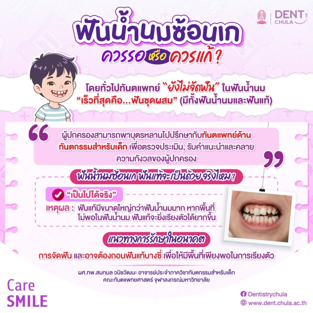 เด็กฟันเก ฟันซ้อน ต้องรีบจัดหรือรอได้ คณะทันตแพทยศาสตร์ จุฬาลงกรณ์มหาวิทยาลัย