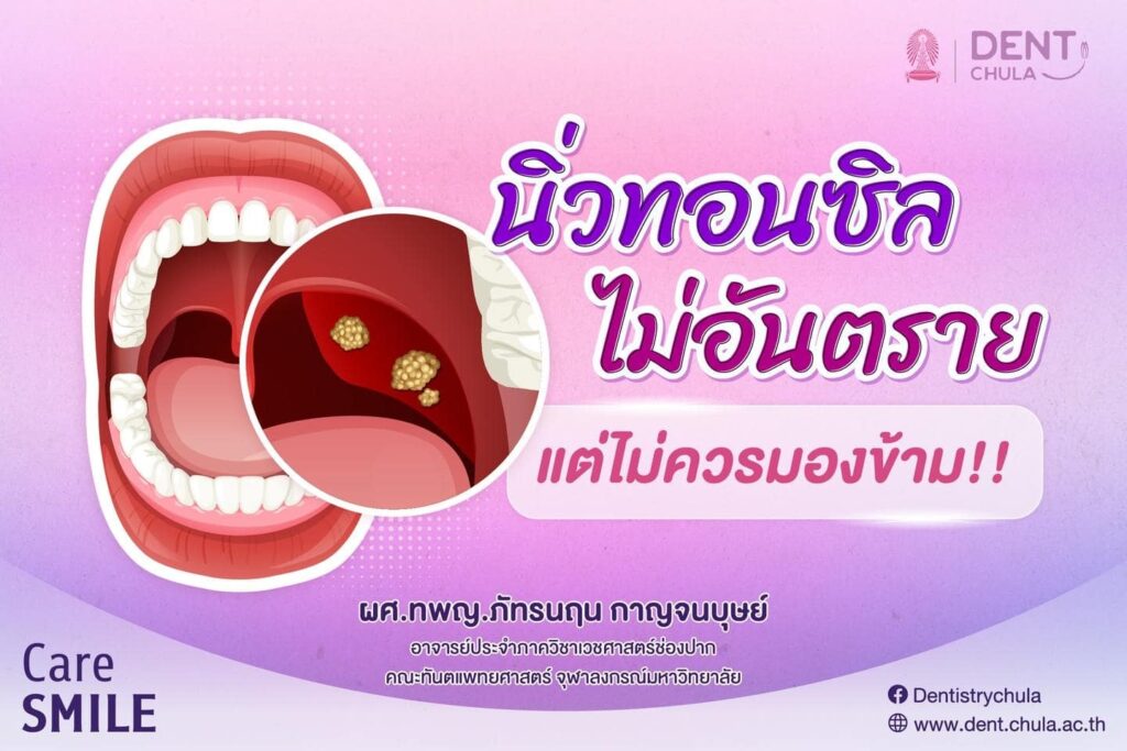 นิ่วทอนซิล 01 คณะทันตแพทยศาสตร์ จุฬาลงกรณ์มหาวิทยาลัย