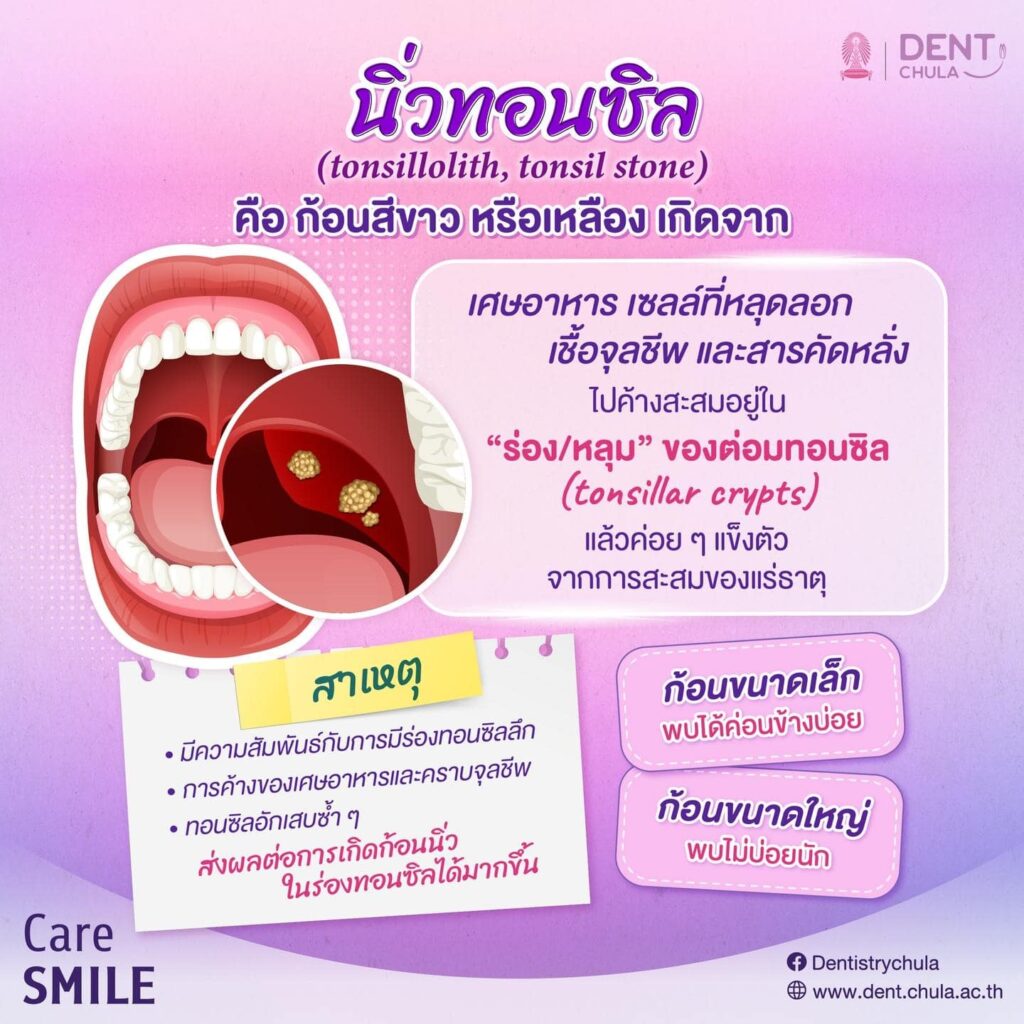นิ่วทอนซิล 02 คณะทันตแพทยศาสตร์ จุฬาลงกรณ์มหาวิทยาลัย