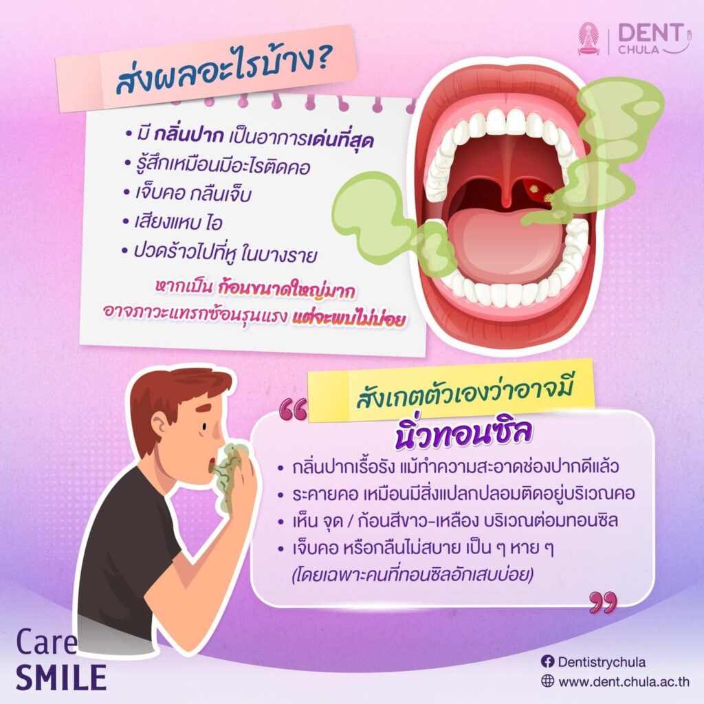 นิ่วทอนซิล 03 คณะทันตแพทยศาสตร์ จุฬาลงกรณ์มหาวิทยาลัย