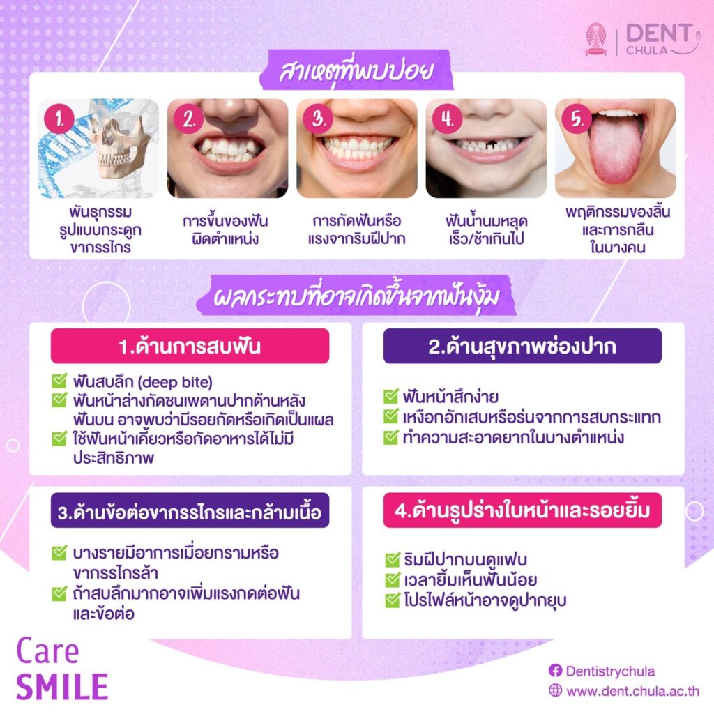 ฟันงุ้ม 2 0 คณะทันตแพทยศาสตร์ จุฬาลงกรณ์มหาวิทยาลัย