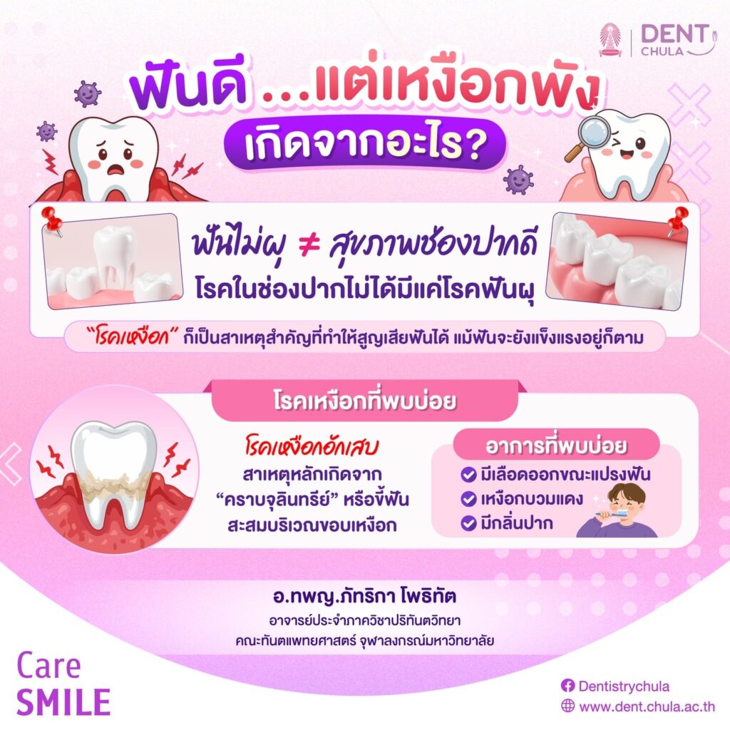 ฟันดี…แต่เหงือกพัง 1 0 คณะทันตแพทยศาสตร์ จุฬาลงกรณ์มหาวิทยาลัย