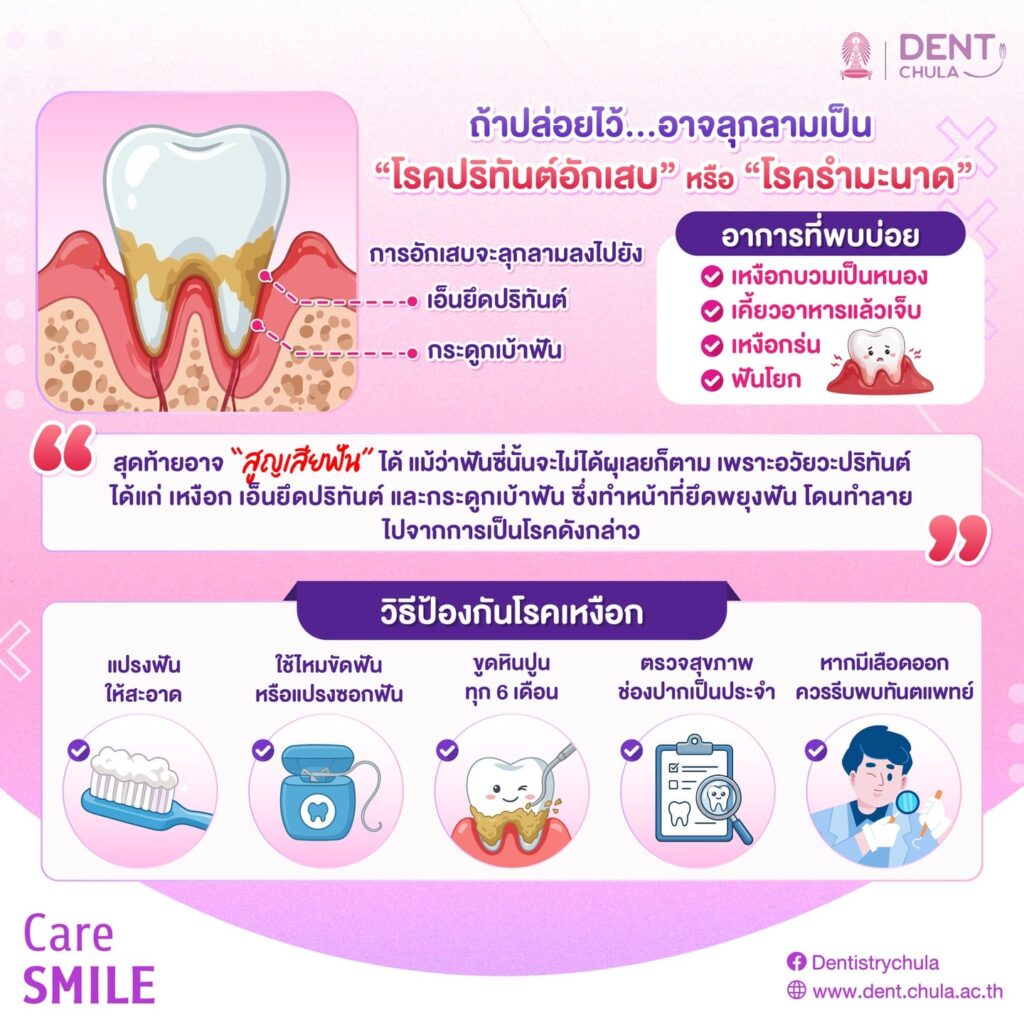 ฟันดี…แต่เหงือกพัง 2 0 คณะทันตแพทยศาสตร์ จุฬาลงกรณ์มหาวิทยาลัย