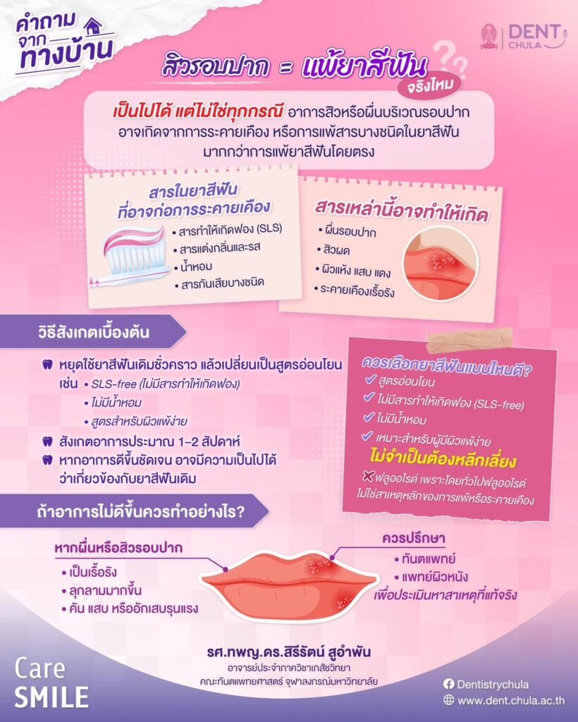 สิวขึ้นรอบปาก เพราะแพ้ยาสีฟัน คณะทันตแพทยศาสตร์ จุฬาลงกรณ์มหาวิทยาลัย