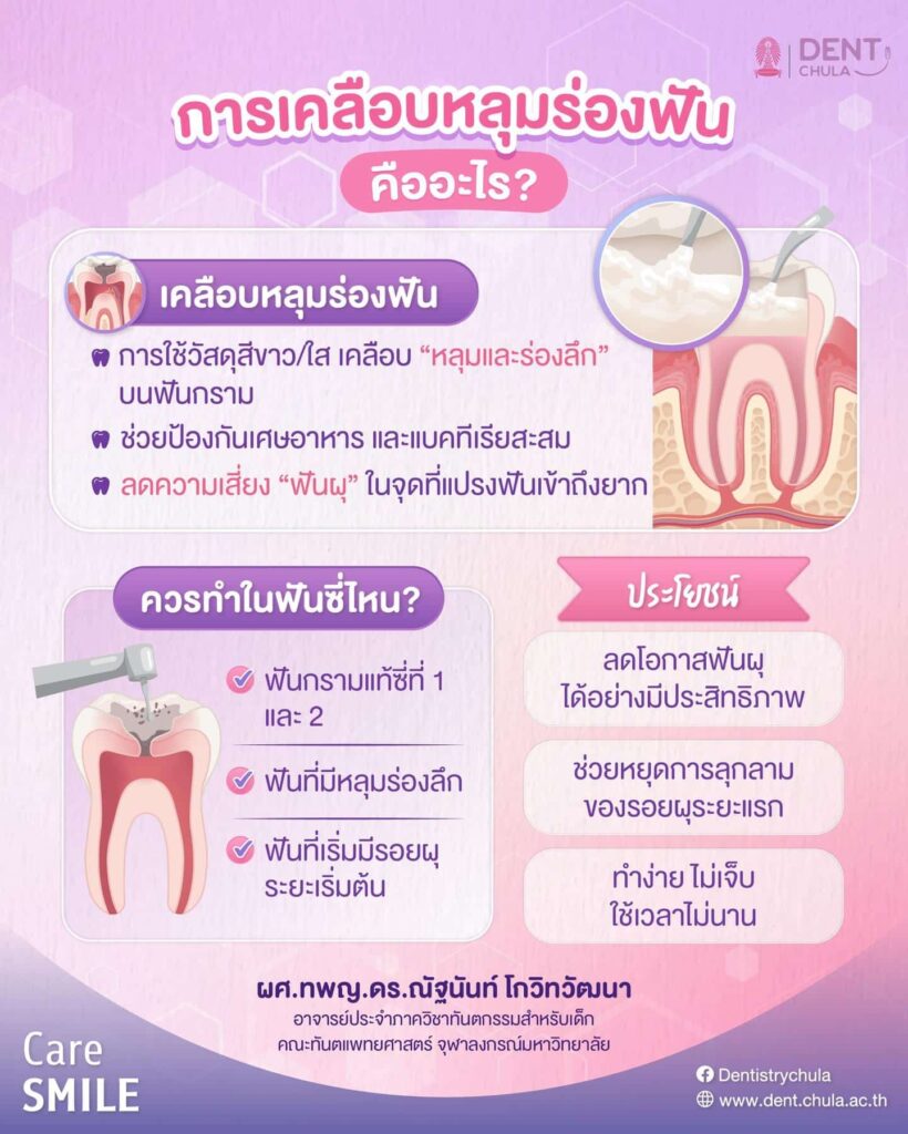 เคลือบหลุมร่องฟัน จำเป็นกับเด็กทุกคนหรือไม่ คณะทันตแพทยศาสตร์ จุฬาลงกรณ์มหาวิทยาลัย