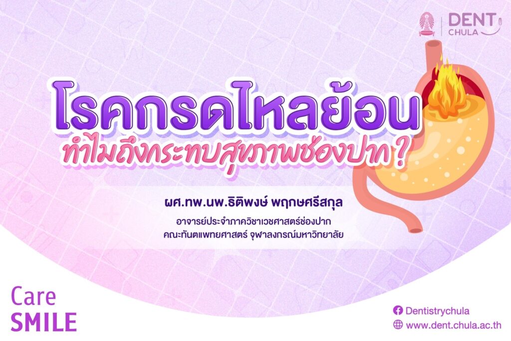 กรดไหลย้อน ทำฟันสึกเร็วกว่าปกติ 1 0 คณะทันตแพทยศาสตร์ จุฬาลงกรณ์มหาวิทยาลัย