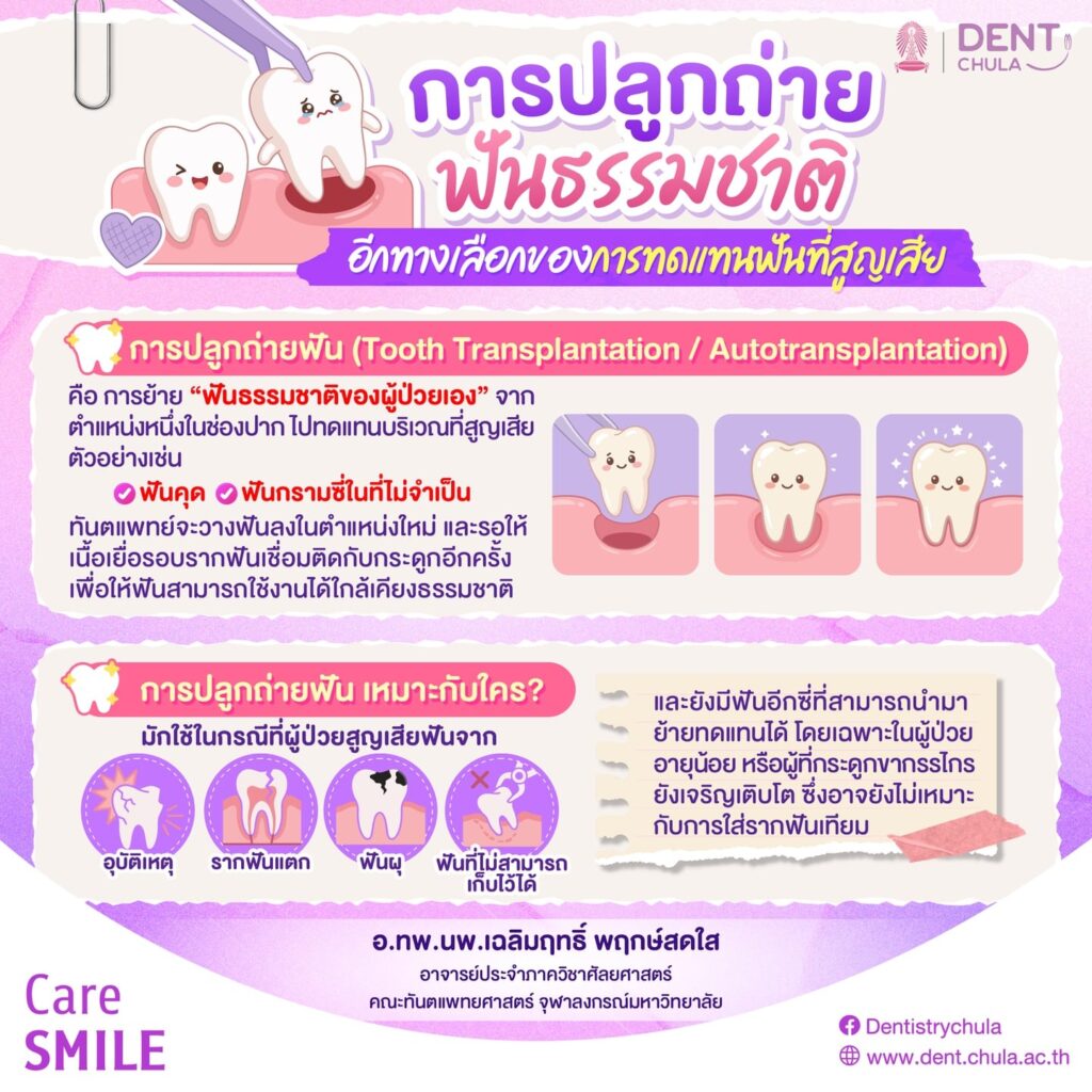 การปลูกถ่ายฟัน 1 0 คณะทันตแพทยศาสตร์ จุฬาลงกรณ์มหาวิทยาลัย