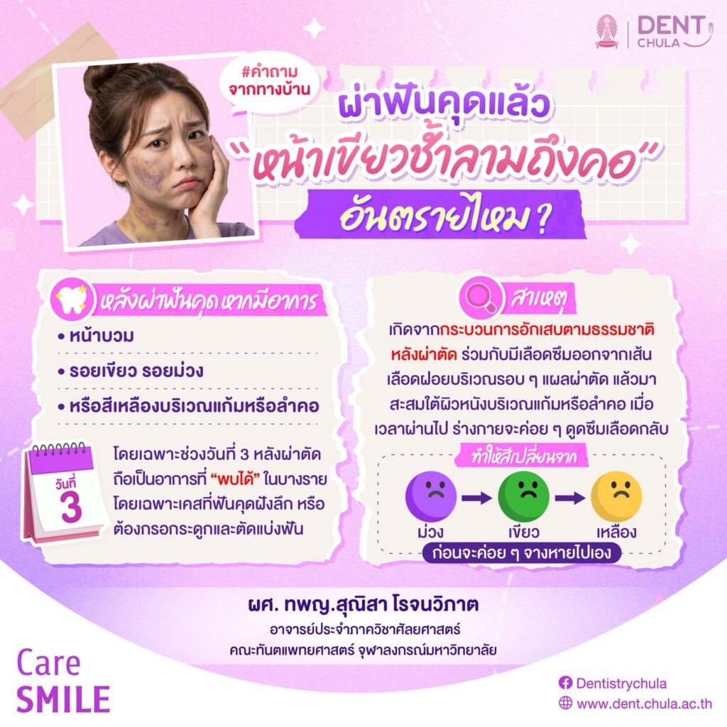ผ่าฟันคุด แต่หน้าช้ำ 1 0 คณะทันตแพทยศาสตร์ จุฬาลงกรณ์มหาวิทยาลัย