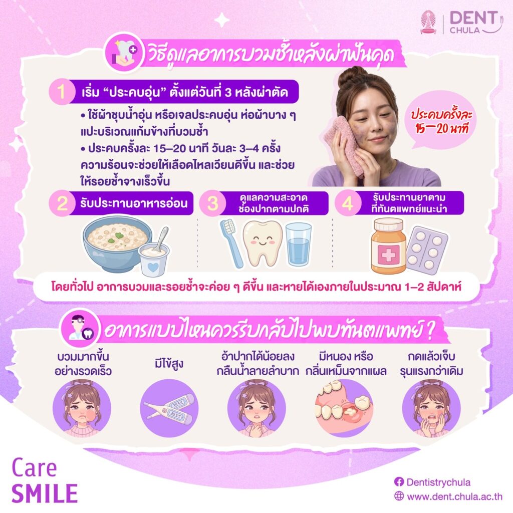 ผ่าฟันคุด แต่หน้าช้ำ 2 0 คณะทันตแพทยศาสตร์ จุฬาลงกรณ์มหาวิทยาลัย