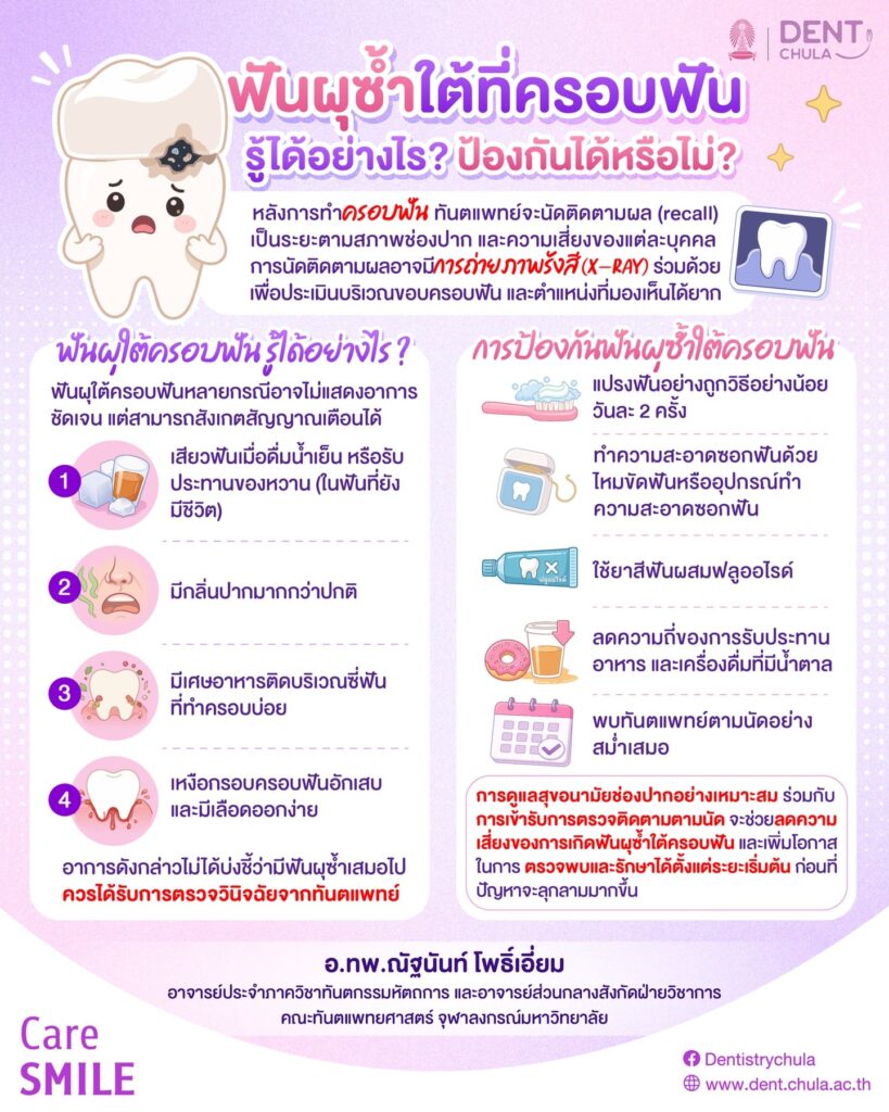 ฟันผุซ้ำใต้ครอบฟัน จะรู้ได้ยังไง คณะทันตแพทยศาสตร์ จุฬาลงกรณ์มหาวิทยาลัย