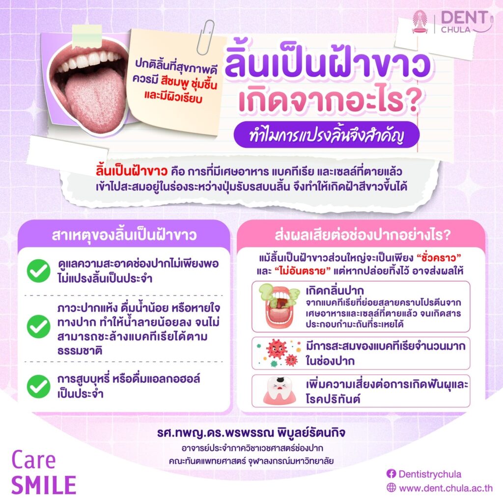 ลิ้น สามารถบอกความสะอาดของช่องปากได้ 1 คณะทันตแพทยศาสตร์ จุฬาลงกรณ์มหาวิทยาลัย