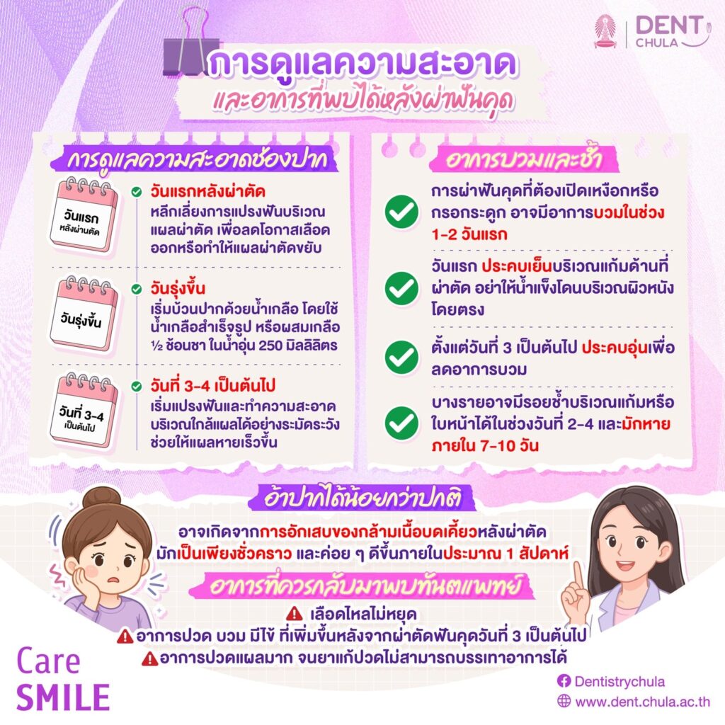 วิธีการดูแลแผลหลังผ่าฟันคุด 2 0 คณะทันตแพทยศาสตร์ จุฬาลงกรณ์มหาวิทยาลัย
