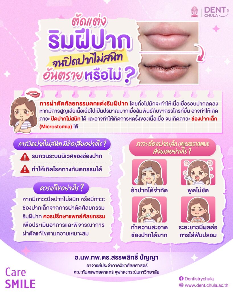 ศัลยกรรมตัดเย็บริมฝีปาก จนเห็นฟัน คณะทันตแพทยศาสตร์ จุฬาลงกรณ์มหาวิทยาลัย