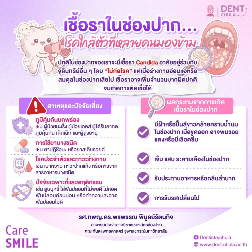 เชื้อราในช่องปาก 1 0 คณะทันตแพทยศาสตร์ จุฬาลงกรณ์มหาวิทยาลัย