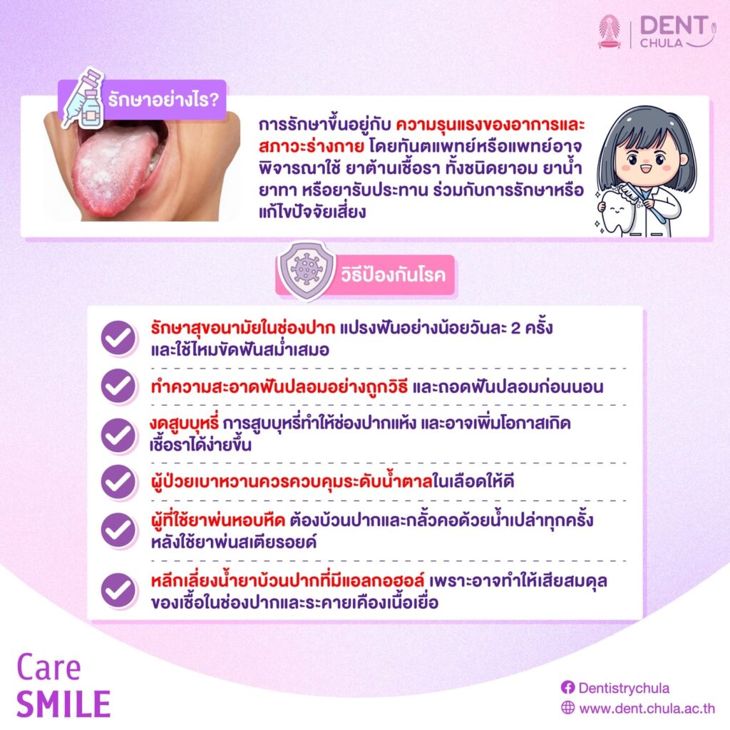 เชื้อราในช่องปาก 2 0 คณะทันตแพทยศาสตร์ จุฬาลงกรณ์มหาวิทยาลัย