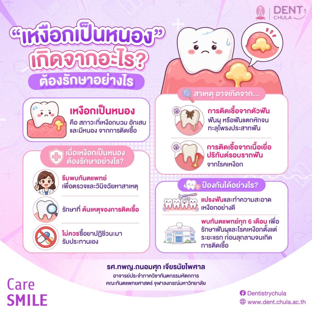 เหงือกเป็นหนอง คณะทันตแพทยศาสตร์ จุฬาลงกรณ์มหาวิทยาลัย