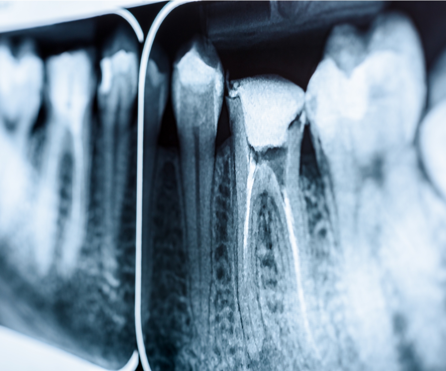 Endodontics คณะทันตแพทยศาสตร์ จุฬาลงกรณ์มหาวิทยาลัย